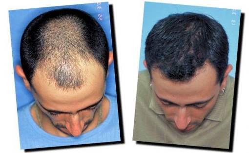 niacin regrow hairline story
